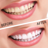 Remedy Health Professional Teeth Whitening Kit – Complete LED Teeth Whitening System